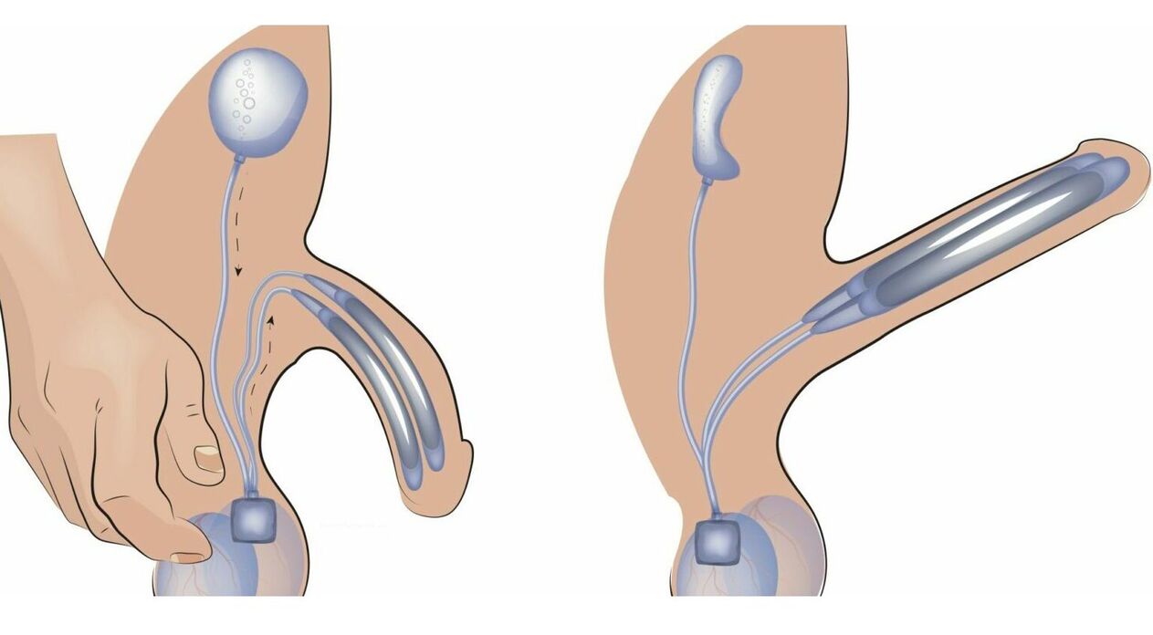 penisna proteza za povećanje penisa